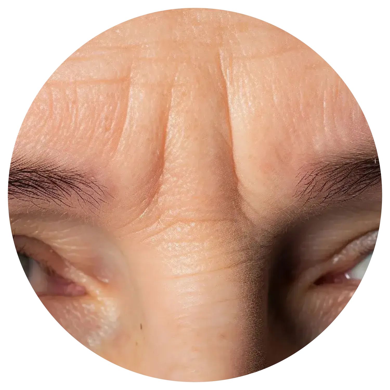 Glabellar lines treatment process at Toronto medical spa - root causes and development